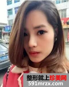 假体隆鼻手术11