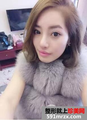 假体隆鼻手术12
