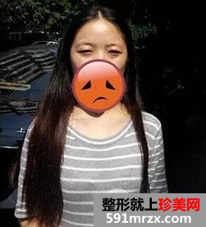 激光去眼袋1