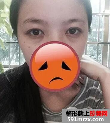 激光去眼袋2
