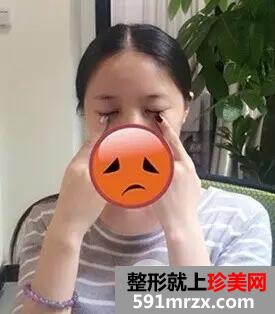 激光去眼袋3