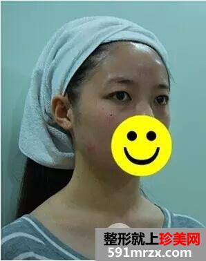 激光去眼袋4