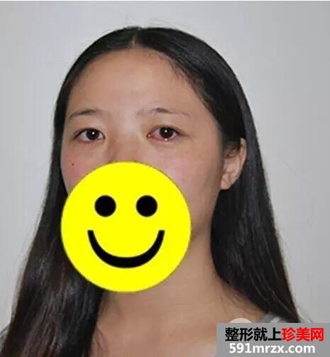 激光去眼袋5
