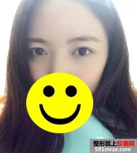 激光去眼袋6