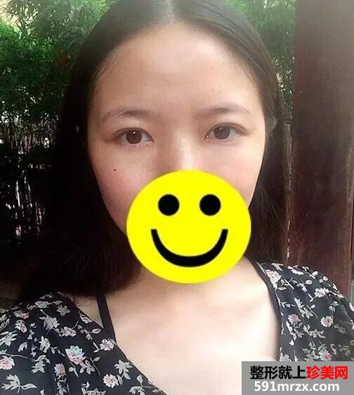 激光去眼袋7