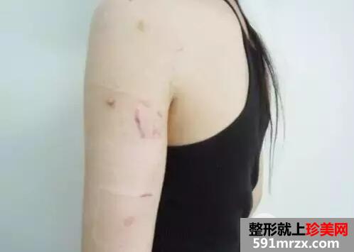 手臂吸脂3