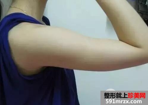 手臂吸脂5