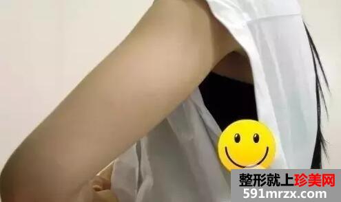 手臂吸脂6