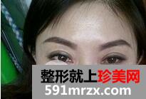 外切法去眼袋1
