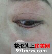 外切法去眼袋2
