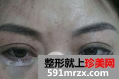 外切法去眼袋3