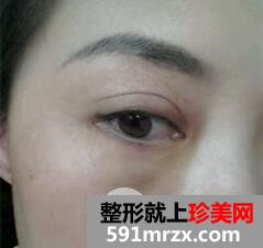 外切法去眼袋5