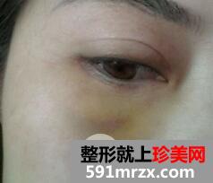 外切法去眼袋6