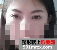 外切法去眼袋7