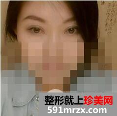 外切法去眼袋8