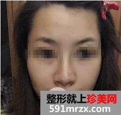 鼻梁宽5