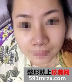 鼻梁宽6