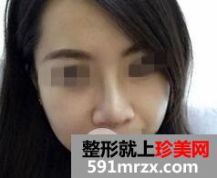 鼻梁宽7