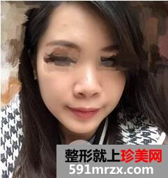 鼻梁宽1