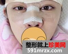 鼻梁宽2