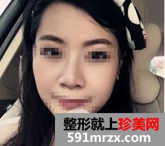 鼻梁宽8