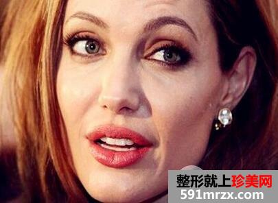 表情纹怎么去掉4