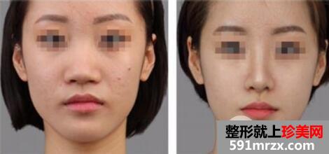 假体隆下巴价格2