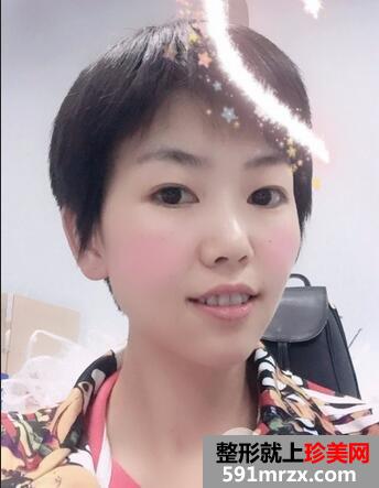 激光祛斑12