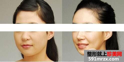去颊脂垫术1
