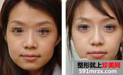 去颊脂垫术2