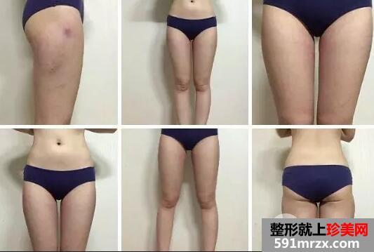 水动力溶脂减肥5