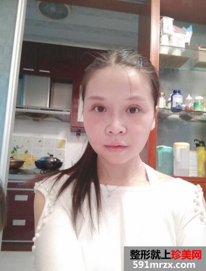 磨骨手术5