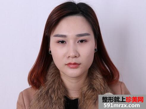 玻尿酸丰额头1