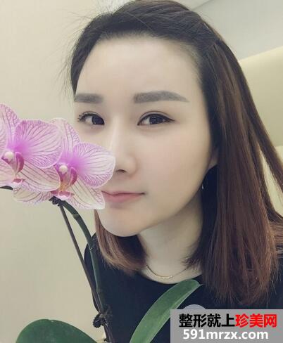 玻尿酸丰额头8