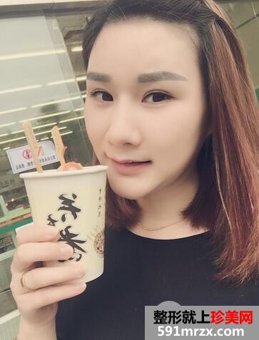 玻尿酸丰额头9