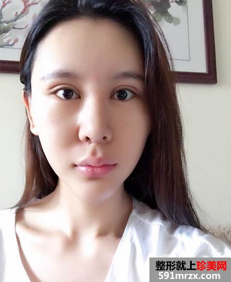 瘦脸针4
