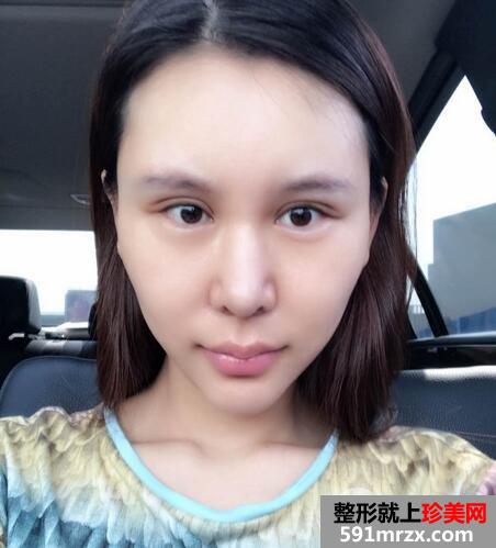 瘦脸针5