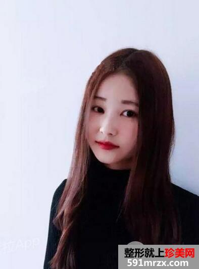 玻尿酸丰下巴2