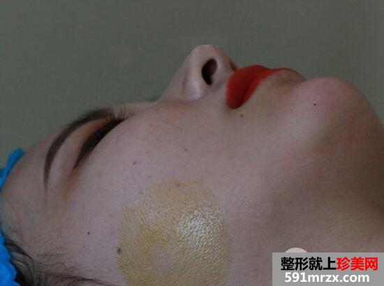 玻尿酸丰下巴5