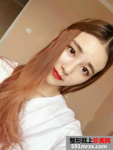 玻尿酸丰下巴7