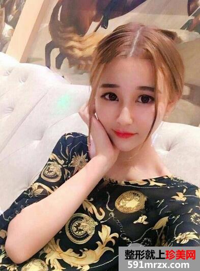 玻尿酸丰下巴9