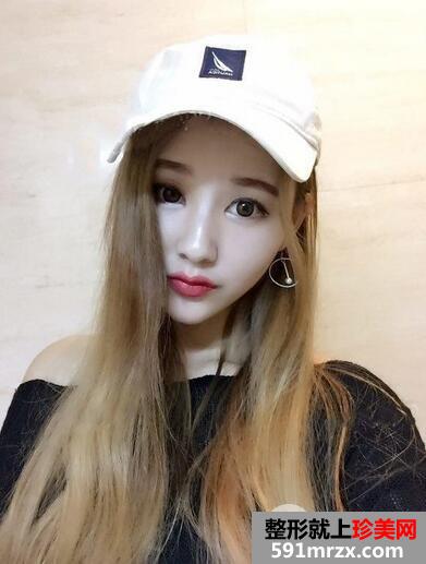 玻尿酸丰下巴11