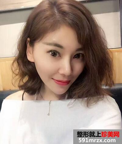 做双眼皮手术安全吗9