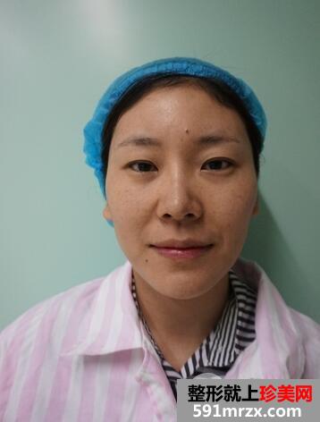做双眼皮手术安全吗2