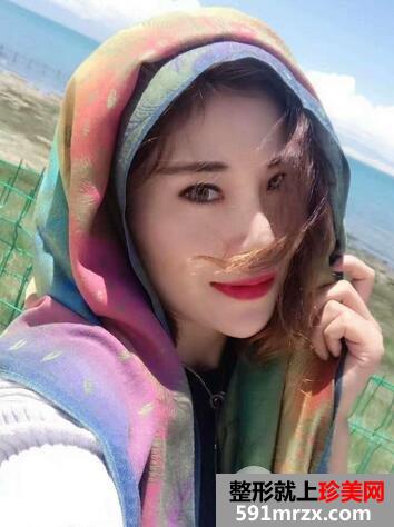 做双眼皮手术安全吗13
