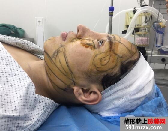 吸脂瘦脸3