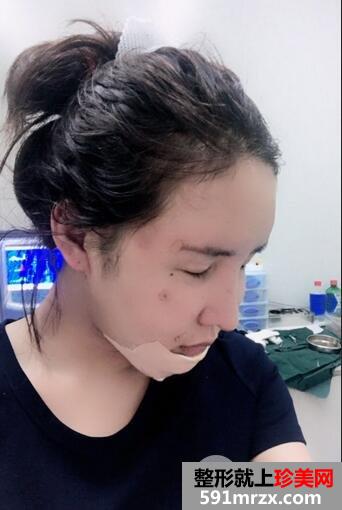 吸脂瘦脸5