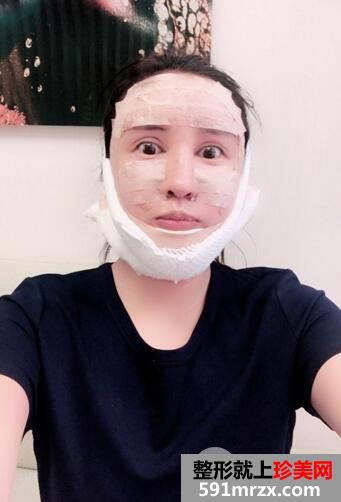 吸脂瘦脸6