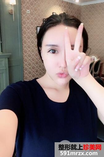 吸脂瘦脸7
