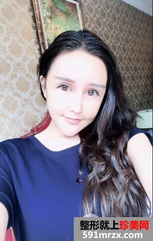 吸脂瘦脸8